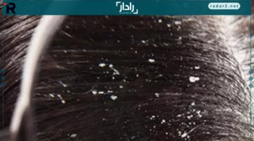 قشرة الرأس.. تعرف على أشهر الأسباب والمحــفزات التي تزيد من ظهورها